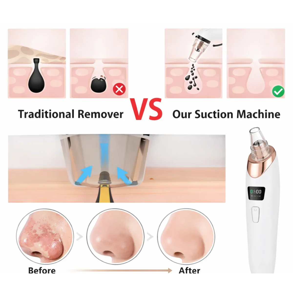 Handled Pore Vacuum Cleaner - Clear Your Pores in 5 Minutes No Squeezing Needed