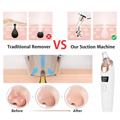 Handled Pore Vacuum Cleaner - Clear Your Pores in 5 Minutes No Squeezing Needed